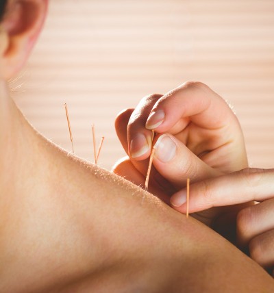 Acupuncture